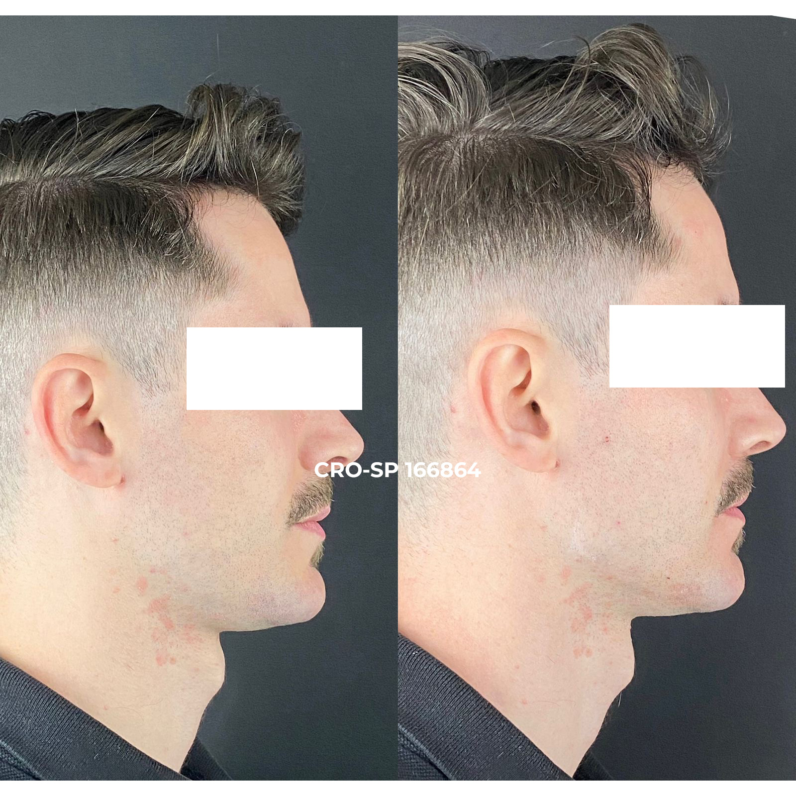 Resultado harmonização orofacial Sorocaba