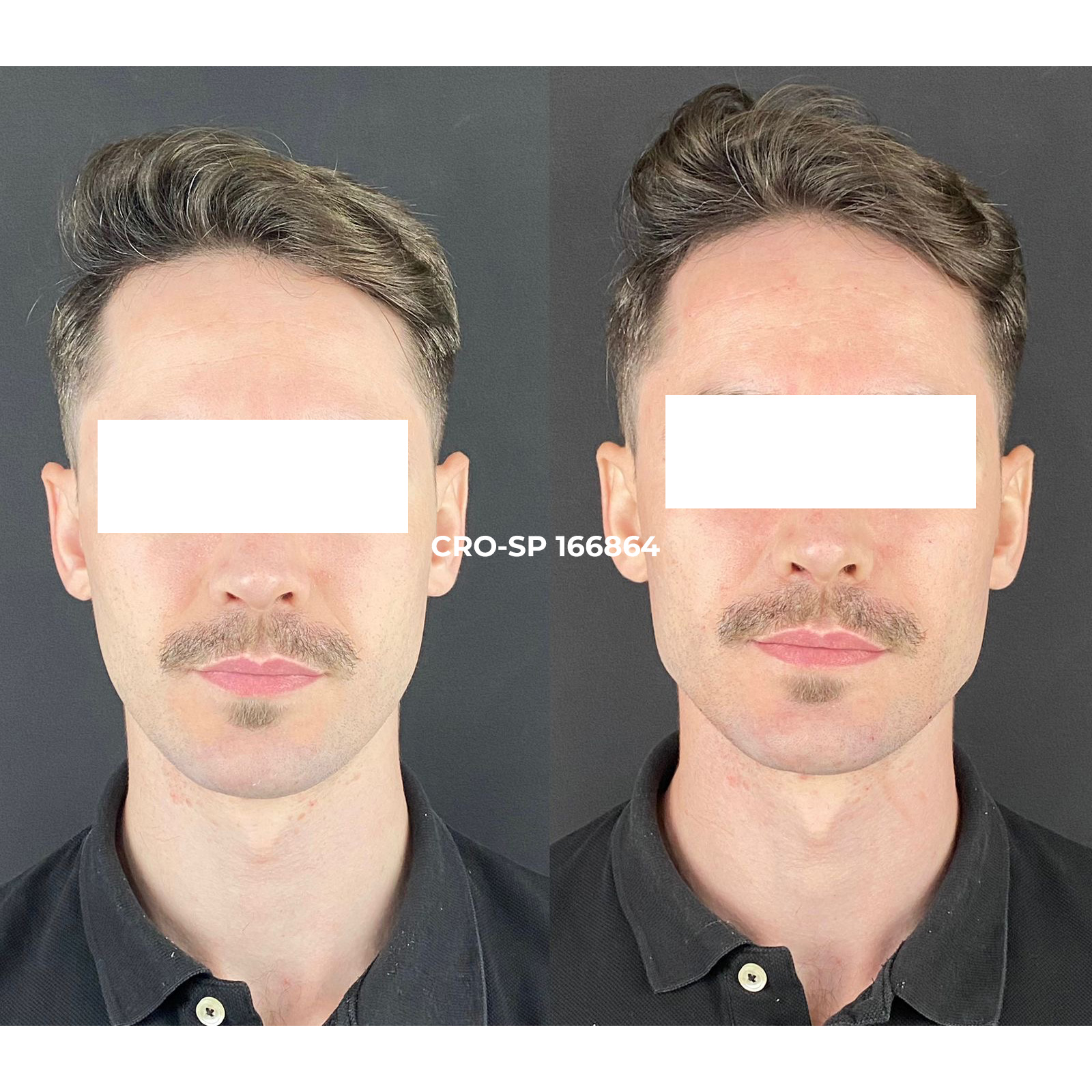 Resultado clareamento dental Sorocaba