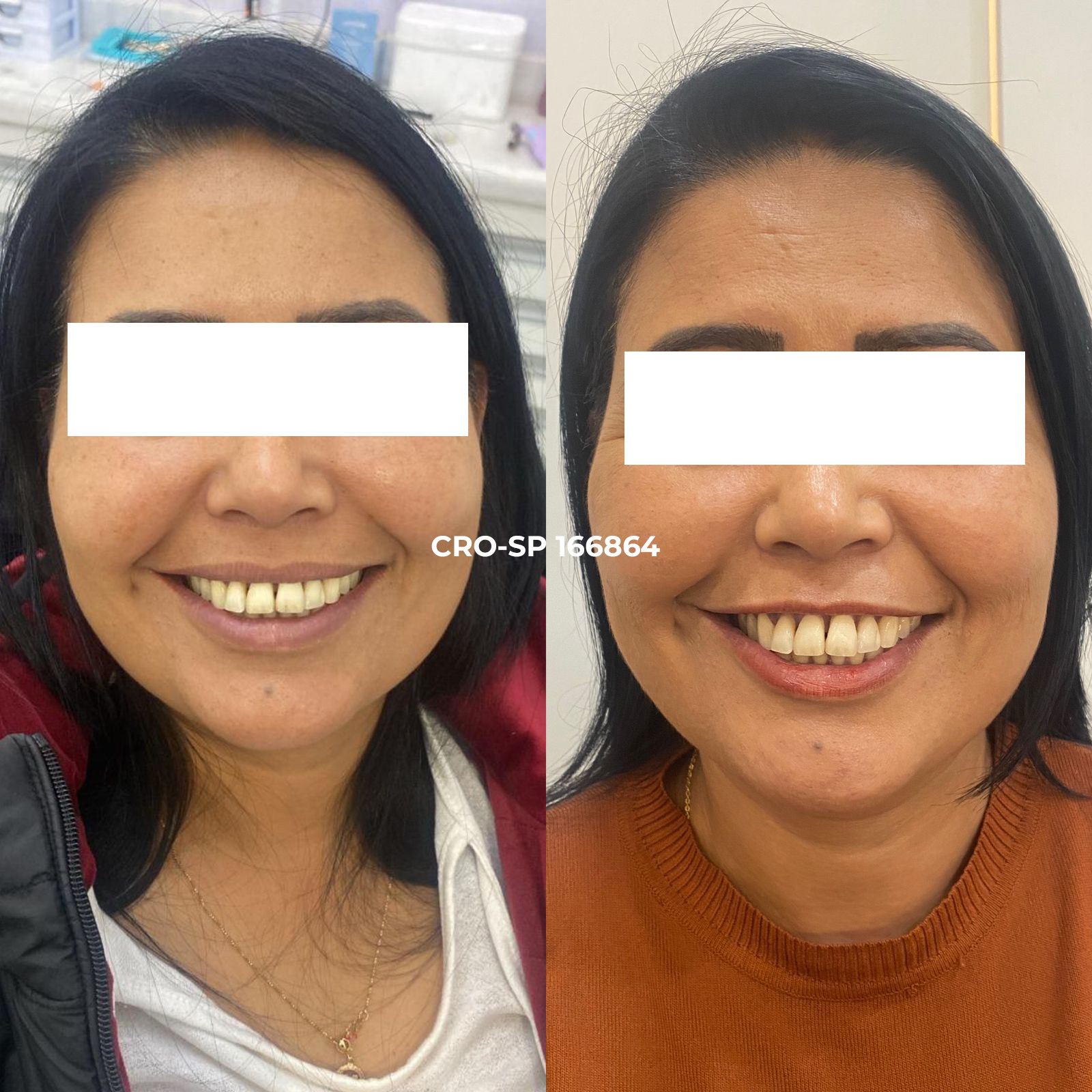 Resultado botox dentista Sorocaba