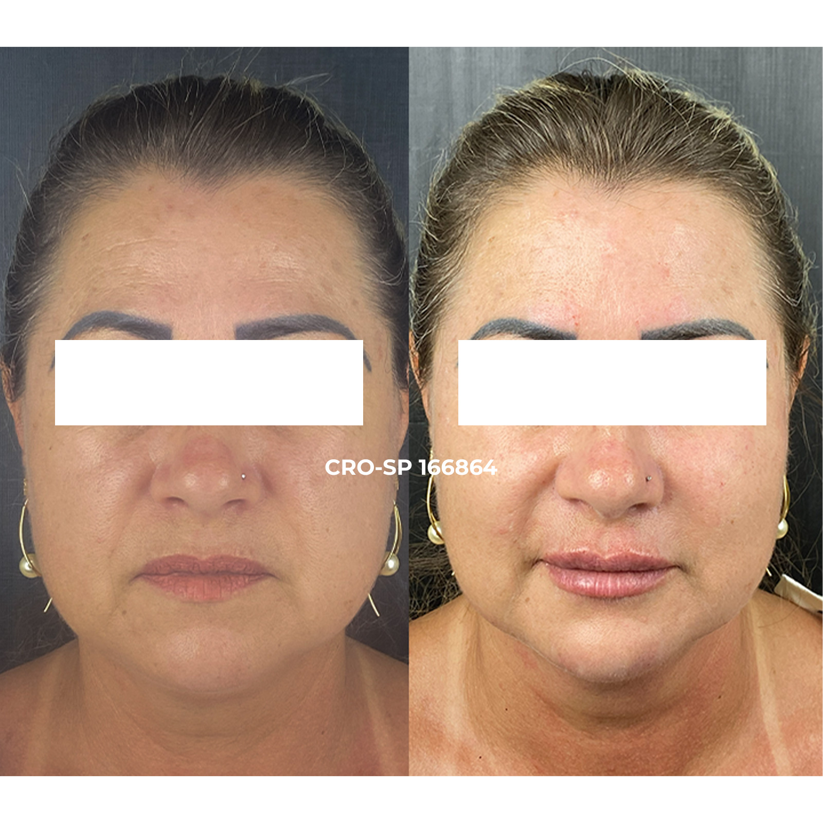 Resultado estética facial Sorocaba